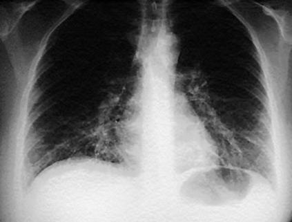 Pneumonia Quadro Clínico Pneumonia Diagnóstico Tiragem (musculatura
