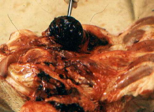 Linfadenite hemorrágica dos linfonodos mesentéricos na Peste