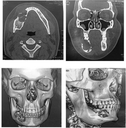 Aos 8 meses de pós-operatório observou-se aumento volumétrico da região de corpo e ângulo mandibular direito, com expansão das corticais ósseas, reabsorção da raiz distal do elemento 46 e mobilidade