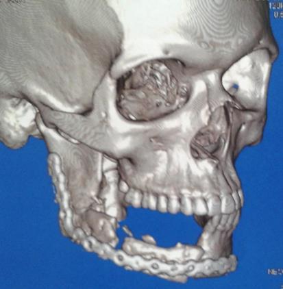 Através da análise de tomografia computadorizada do pós-operatório imediato pode-se observar um satisfatório contorno e simetria da face obtida com a placa de reconstrução e a estável adaptação do