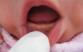 Orofaringe nos primeiros dias de vida, pode apresentar-se normalmente avermelhada. As amígdalas palatinas não são visíveis e irão hipertrofiar-se somente após o contato com microorganismos.