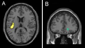 A diferença de tamanho é verificada em estruturas cerebrais relacionadas à