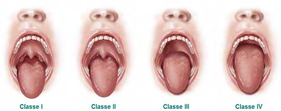 32 Figura 2 - Classificação de Mallampati modificada por Samsoon e Young: Classe I: palato mole, úvula e pilares visíveis; Classe II: palato mole e úvula visíveis; Classe III: palato mole e base da