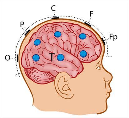 2 Para diferenciar as áreas homólogas dos hemisférios cerebrais, utilizam-se números pares no hemisfério direito (Fp2, F4, F8, C4, P4, T4, T6 e O2) e ímpares no esquerdo (Fp1, F3, F7, C3, P3, T3, T5