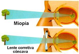 5.3 DEFEITOS DO OLHO HUMANO 5.3.1 -