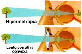 5.3 DEFEITOS DO OLHO HUMANO 5.3.2 - Hipermetropia A imagem se forma após a retina.