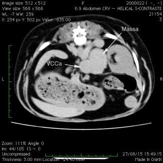 4 Figura 1 TC. Massa em adrenal direita medindo cerca de 3,8 x 3,0 x 5,0 cm (A x L x C) invadindo veia cava caudal. Fonte: CRV Imagem Icaraí.