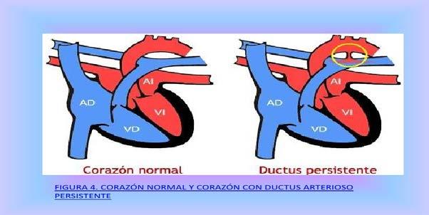 Persistência do Ductus Arteriosus O ductus arteriosus, o grande vaso sangüíneo que liga a artéria pulmonar à aorta descendente durante a vida fetal, geralmente se fecha por constrição em poucas