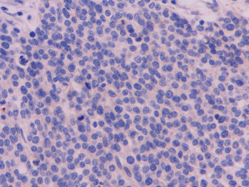A B C D Figura 11: Cadela. Glândula Mamária. Carcinoma Sólido.
