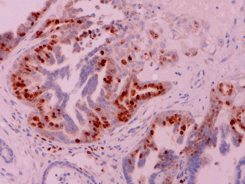 glandulares com células epiteliais