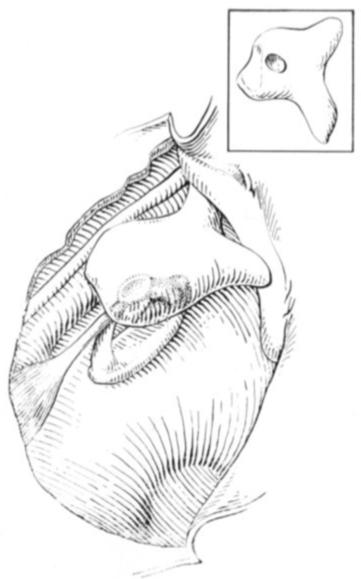 técnicas de interposição de bigorna (dentre outras) para as otites médias crônicas com erosão ossicular (mais os casos de luxação traumática).
