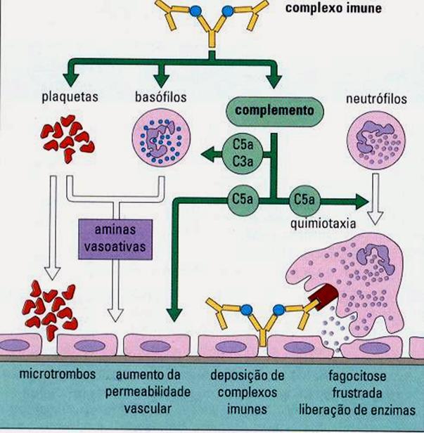 Hipersensibilidade tipo III Mediada por imunocomplexos Produção de imunocomplexos nas circulação. Deposição dos imuncomplexos na célula alvo.