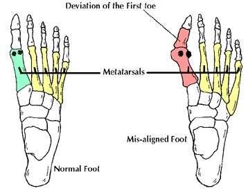 Figura 7 - Hallux Abductus Valgus (8) No entanto, a deformidade hallux valgus é complexa, estruturalmente variável e com manifestações clínicas de diferentes espectros de gravidade.