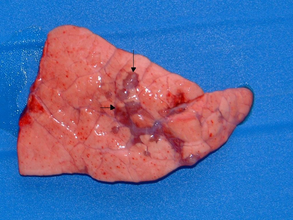 Lesões tuberculosas no parênquima pulmonar.