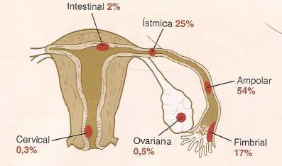 Gravidez ectópica Nota: O termo correto é intersticial e não intestinal.