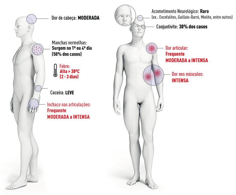 Tratamento Não existe tratamento específico para Dengue. O tratamento é feito para aliviar os sintomas.