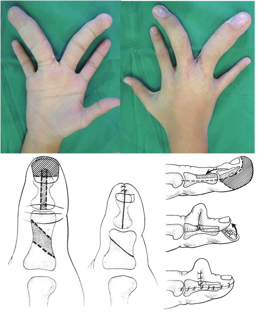do membro. O local mais típico desse tipo de defomidade é o polegar. Ocorre uma falha no crescimento de todas as estruturas que compõem o dedo (osso, tendão, músculos, ligamentos).
