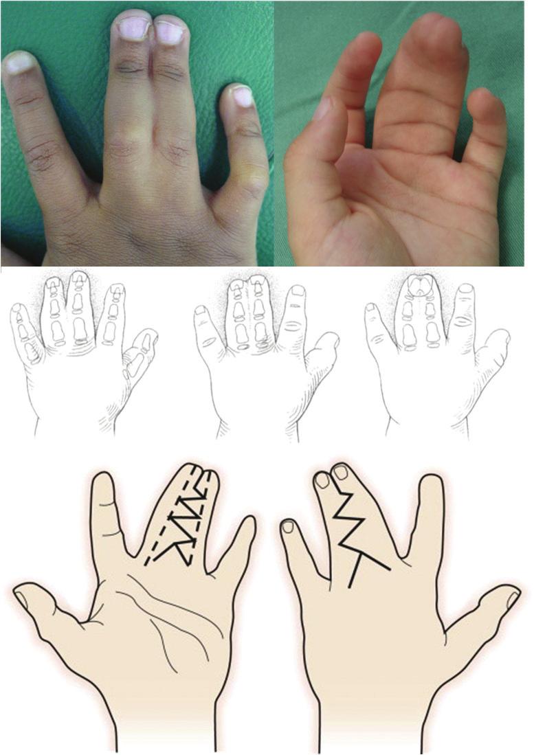 Primeiramente porque após a divisão dos dedos ocorre falta de pele, sendo necessário o uso de enxerto em quase todos os pacientes, e também porque se deve priorizar a reconstrução do espaço
