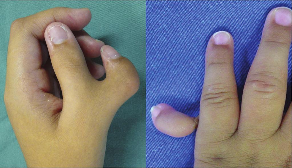 menos frequência acontece nos dedos centrais.