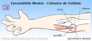 Testes especiais Epicondilite medial Teste para Epicondilite Medial (golfista):paciente sentado, estende o cotovelo e supina a mão; paciente vai flexionar o punho contra