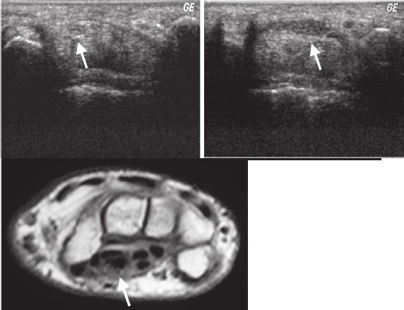 Túnel do carpo proximal normal: imagem por RNM no plano axial Ultra-som do