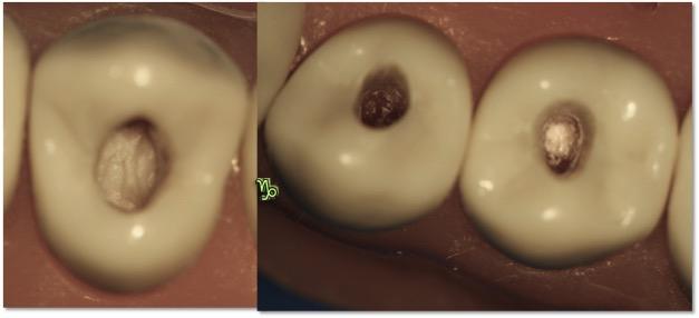 15 Figura 16 - Forma de contorno do acesso no Primeiro Pré-molar superior [esquerda] e Pré-molares inferiores [direita] Tanto no primeiro quanto no segundo molar superior, a forma de contorno é