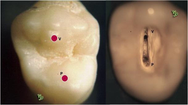 Nos dentes multirradiculares, como o primeiro pré-molar superior, a entrada do canal vestibular está abaixo da cúspide vestibular e do canal palatino abaixo da cúspide palatina [Figura 23].