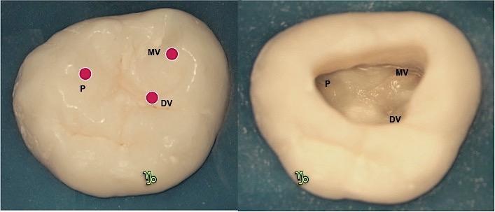 abertura única com o canal mésio-vestibular], necessitando de ser localizado com desgastes especiais [manobra clínica cautelosa] [Figura 24].