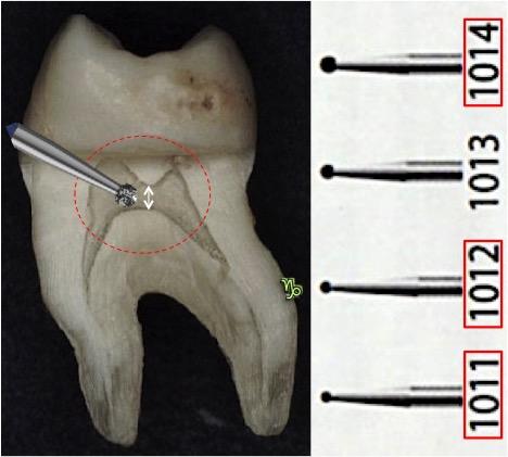[paredes vestibulares de dentes anteriores e soalho dos dentes multirradiculares] [Figura 1]. Figura 1 - Perfurações e desgastes excessivos das estruturas coronárias.