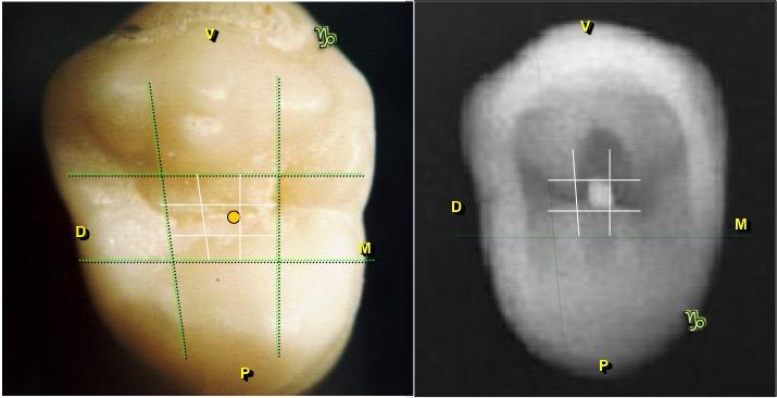 8 2.b.2) DENTES POSTERIORES: PRÉ-MOLARES Nos dentes posteriores pré-molares o ponto de eleição fica na superfície oclusal.