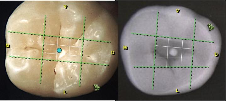 aplicado ao segundo molar inferior 2.