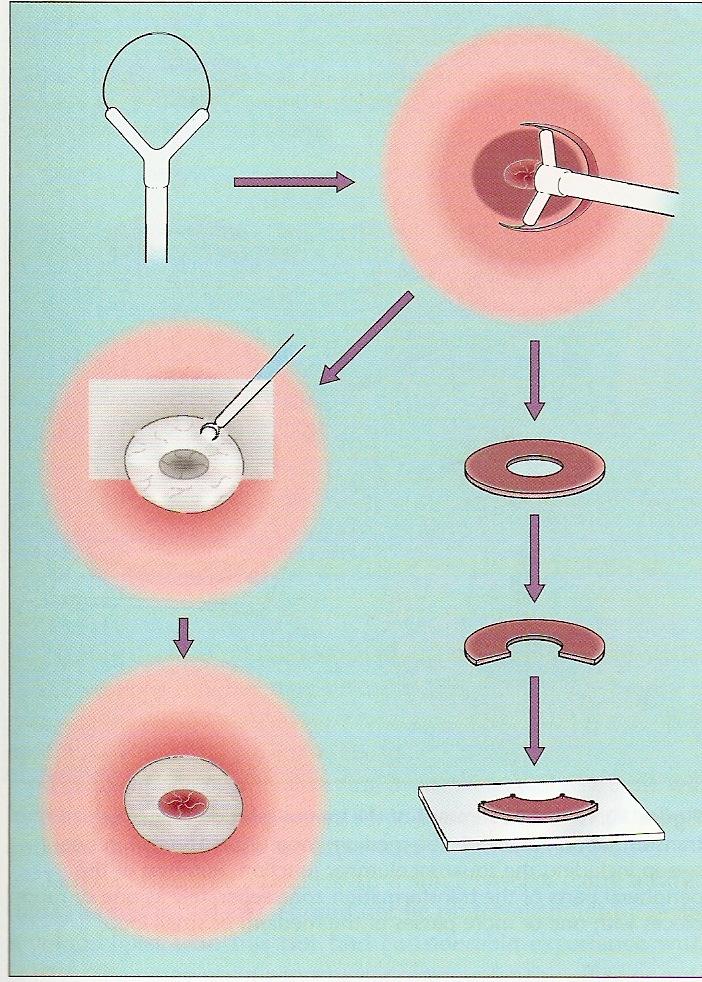 21 electrosurgical excision procedure procedimento eletrocirúrgico excisional com alça) (Ferenczy, 1993) se referem a qualquer procedimento eletrocirúrgico excisional do colo uterino.