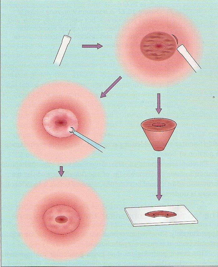 precisar sua extensão (American College of Obstetricians and Gynecologists, 2008) Zonas de transformação tipos 2 ou 3 (Walker et al., 2003).
