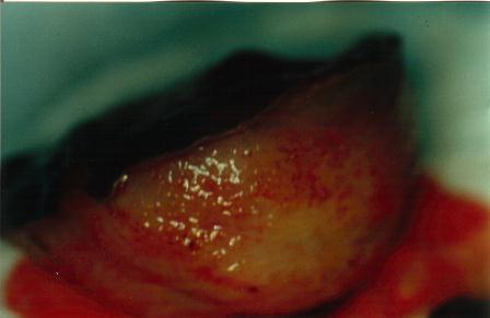 Margens cirúrgicas comprometidas por lesão pré-invasiva Ao se realizar o tratamento excisional eletrocirúrgico, a peça é enviada para análise histopatológica.