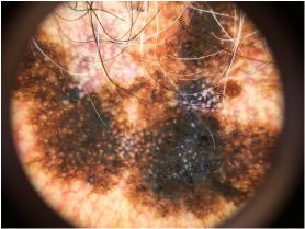 D Assumpção DGC, Chagas GCC, Guedes JCR, Verardino GC. Figura 5: Foto da dermatoscopia do melanoma na região temporal com aumento de 10X e luz polarizada.