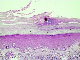 Melanomas primários sincrônicos: aspectos dermatoscópicos. Figura 7: Foto do exame histopatológico da lesão plantar, corado com hematoxilina e eosina e aumento de 200X.