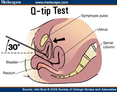 Q-tip