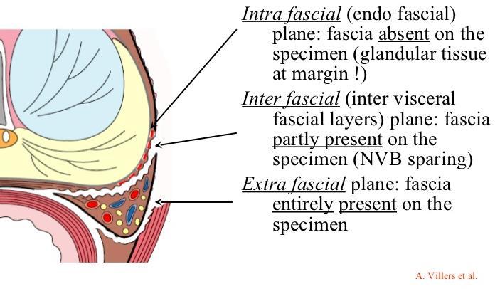 Radioterapia externa Cirurgia de HBP Lesões