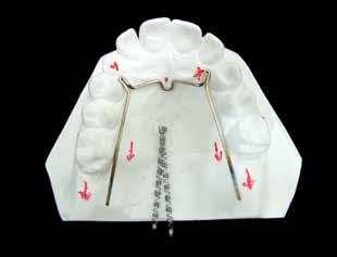 114 transpalatina com função de distalização dos molares, necessitando para isso uso de ancoragem dentária e elásticos cl II e sliding jig como auxiliares na distalização.