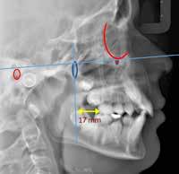 A figura 3C mostra a avaliação cefalométrica de Rickttes, idade (10 anos) + 3 mm, mostrando que o molar