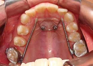 118 Figura 18 Distalização do molar do lado esquerdo. Figura 19 Aperto com alicate de corte a mesial do tubo simples para ancoragem.