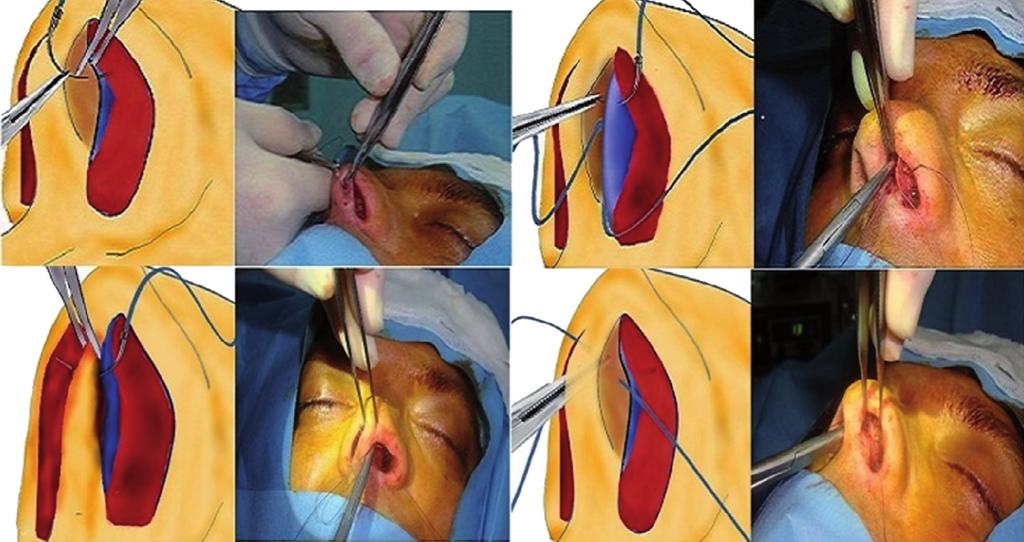 Two-level septocolumellar suture technique for correcting septal caudal dislocation 405 C Figura 1 Sequências da sutura septocolumelar superior.
