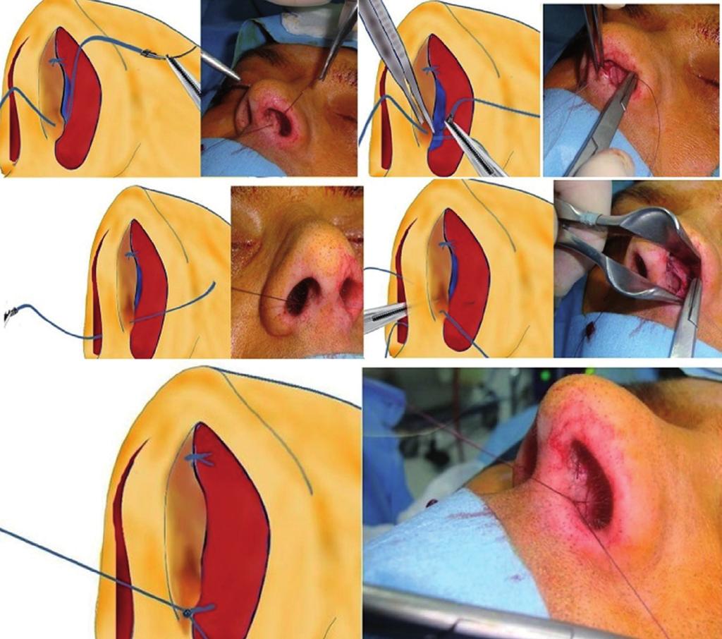 406 Demirbilek N et al. C D E Figura 2 Sequências da sutura septocolumelar inferior. midades nasais anatômicas. septoplastia é uma das principais cirurgias na prática otorrinolaringológica.