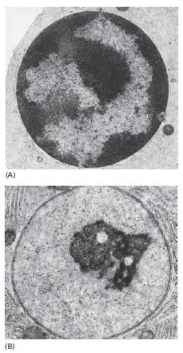 Cromossomos interfásicos Eucromatina e Heterocromatina Heterocromatina : região de cromatina mais compactada, onde os