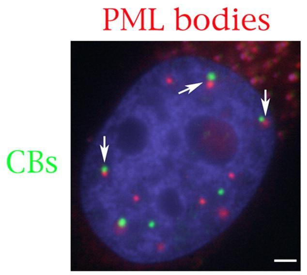 PML (Promyelocytic Leukemia bodies) Parecem ser alvo em infecções virais; Proteína PML encontra-se fusionada com a