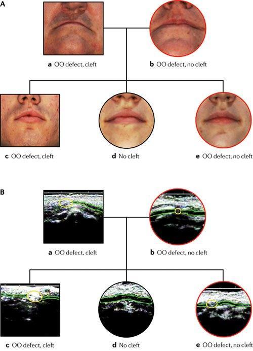 análise de fenótipos sub-clínicos. Alguns destes fenótipos sub-clinicos são: anomalias dentárias, lip pits, defeitos no músculo orbicular da boca.
