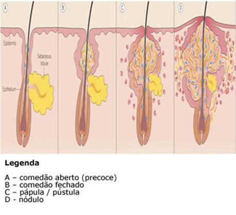 21 Cicatriz: depressão irregular resultante da destruição do folículo pilossebáceo por reação inflamatória.