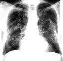 Doenças lisossômicas: -Silicose ou Asbestos afecções pulmonares; -Partículas de sílica ou amianto acumulamse nas células dos