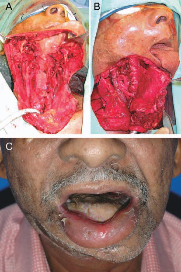 FIGURE 2. Reconstruction of a circumferential hypopharyngeal defect and cutaneous defect in a patient undergoing salvage laryngopharyngectomy for recurrent laryngeal cancer.
