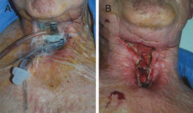 FIGURE 3. Use of negative pressure dressing to manage a wound dehiscence after narrow field salvage laryngectomy. (A) A seal can be achieved by insertion of an 8.0 or 8.